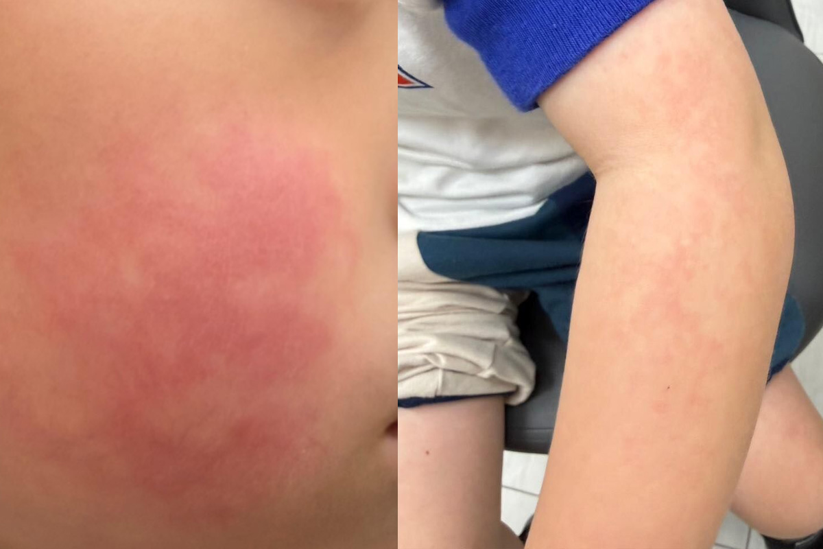 「蘋果病」三階段病程一次看　兒科醫師示警：透過飛沫接觸傳染