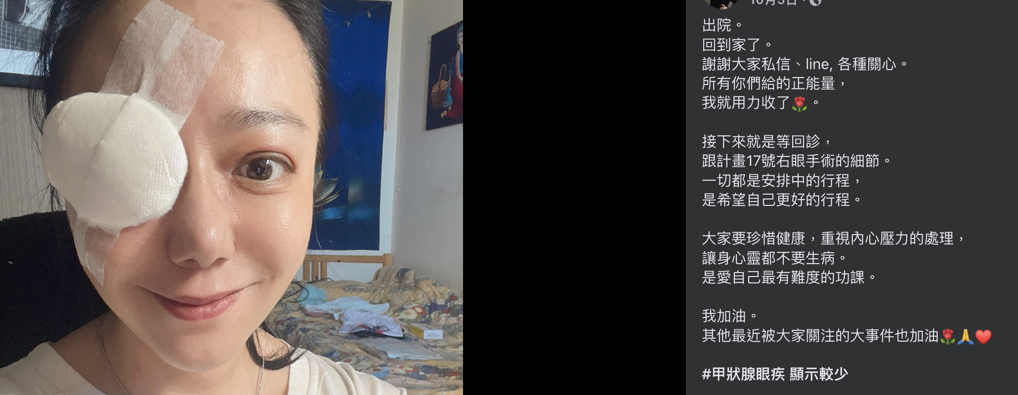 高慧君甲狀腺眼疾險失明。(圖/高慧君FB)