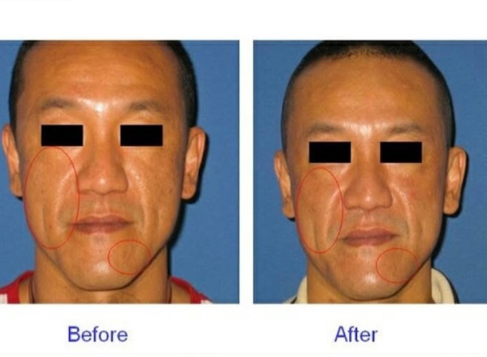 陳為民做醫美的照片瘋傳，即使打馬賽克還是被認出。（圖／翻攝自Threads）