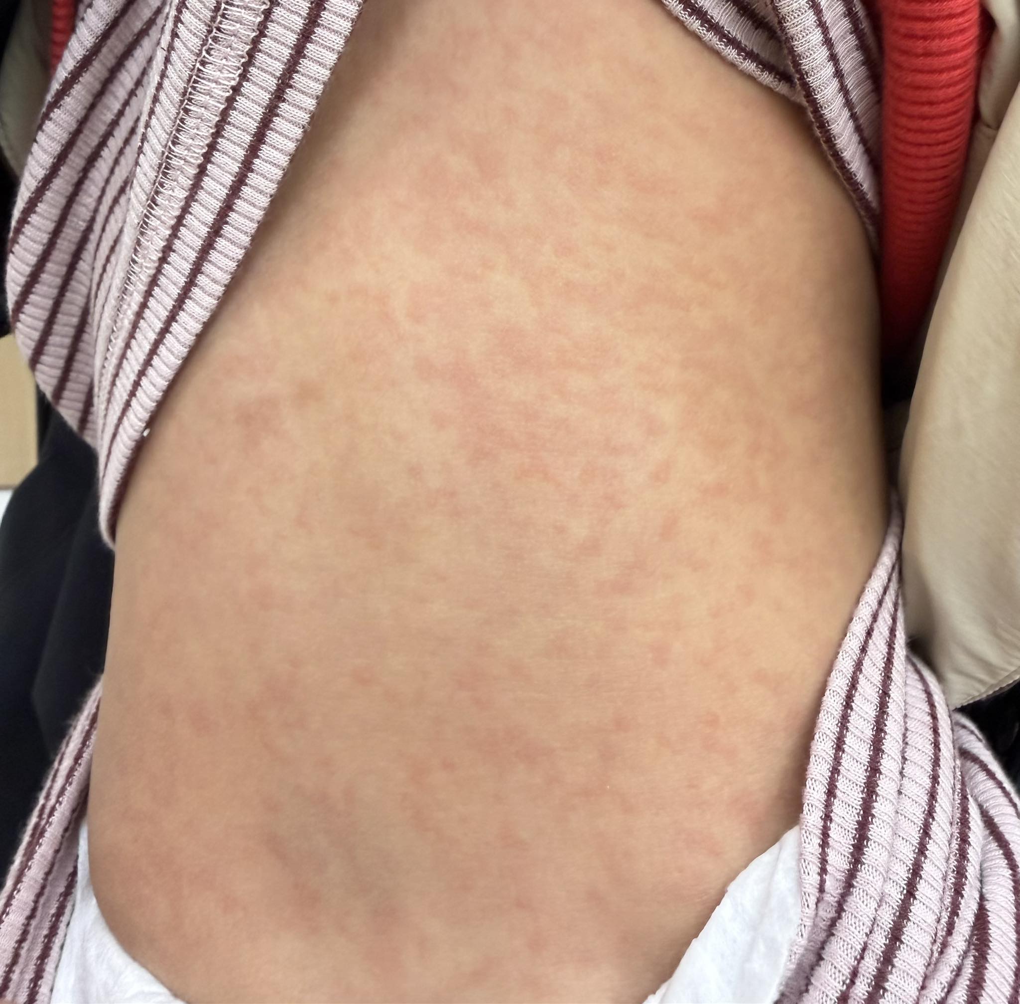 孩童因穿刷毛衣服，皮膚接觸導致紅疹。（圖／翻攝自顏俊宇醫師臉書）