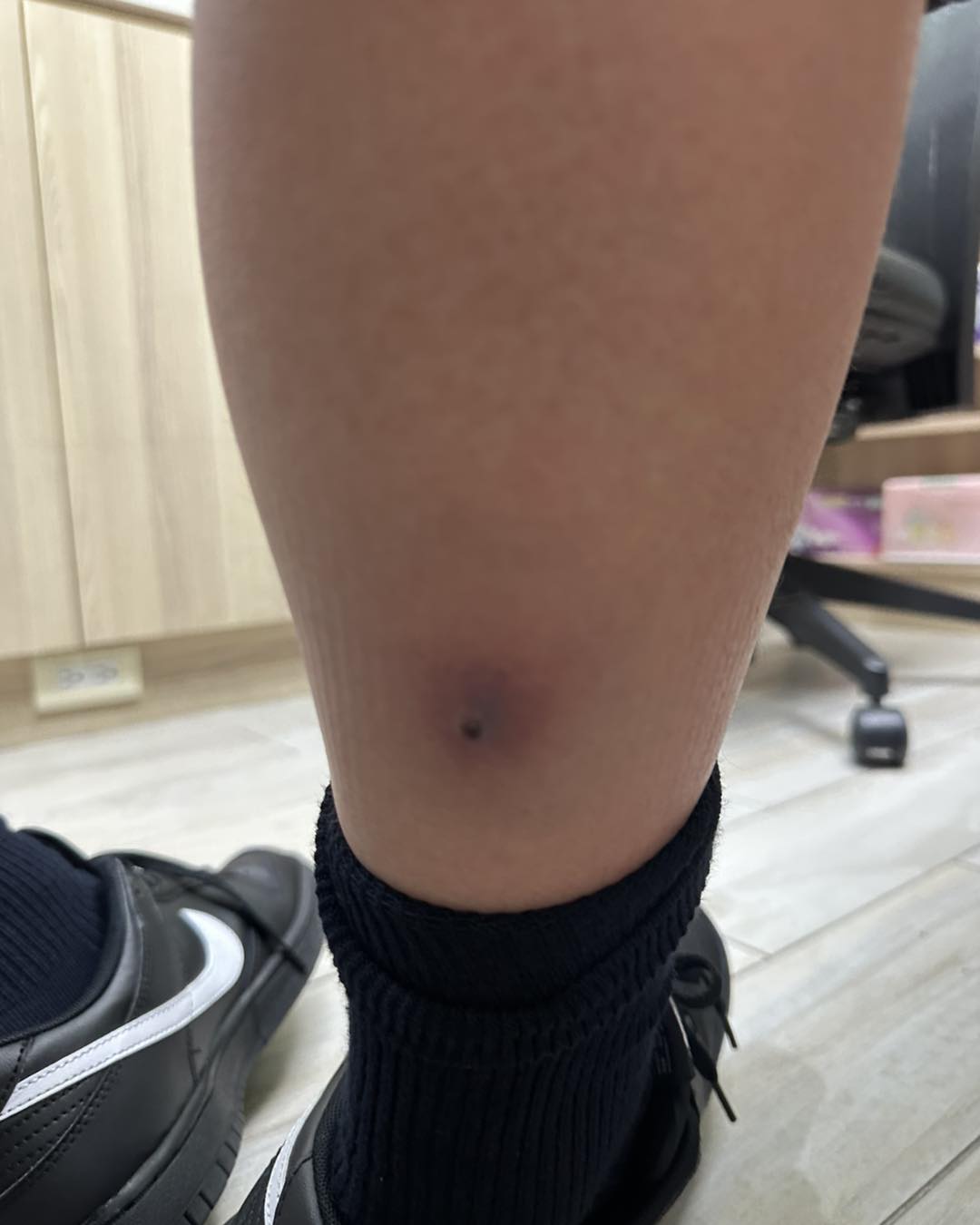 男童小腿紅腫壓痛，並非一般流感。（圖／翻攝自旭恩小兒科診所臉書）