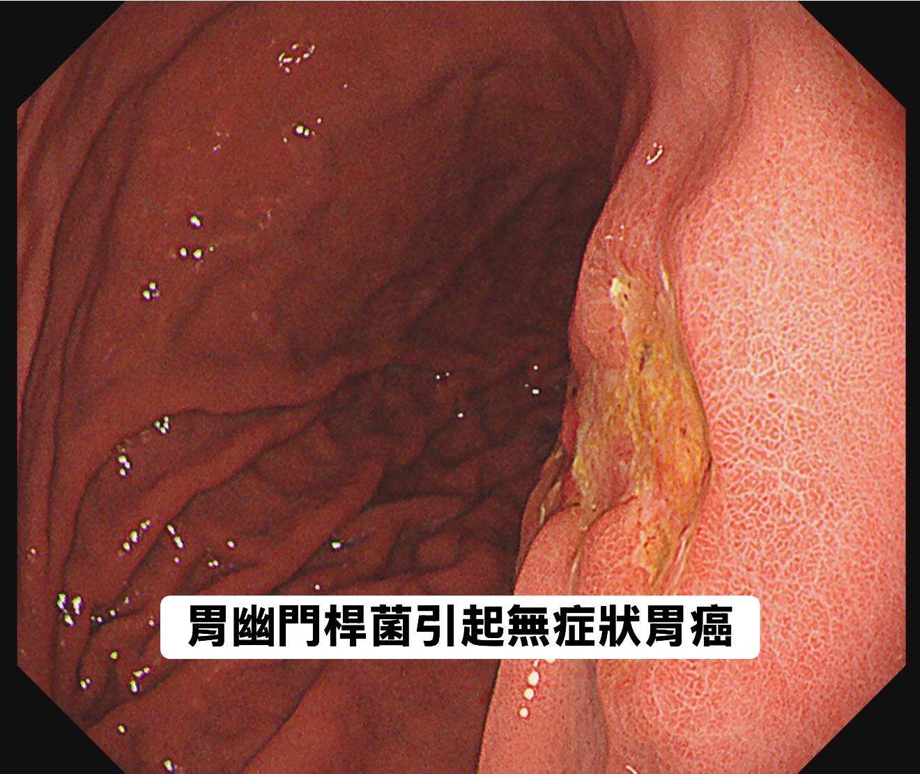 病患平常偶爾有胃脹氣的症狀。(圖/翻攝自林相宏臉書)