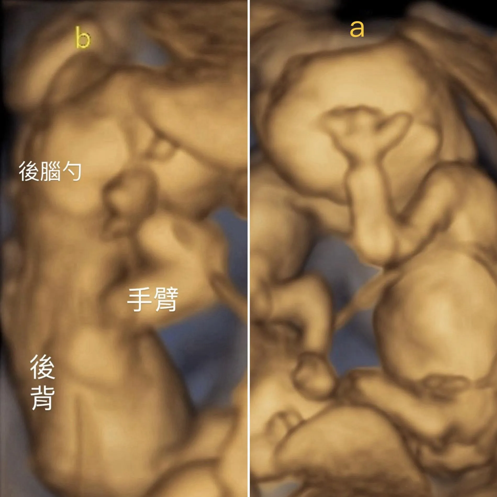 雙胞胎大小都符合週數。（圖／翻攝自鄭家純﻿臉書）