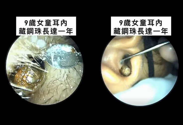 醫師第一次遇到這樣的案例。（圖／翻攝自李典憲 耳鼻喉科醫師臉書）