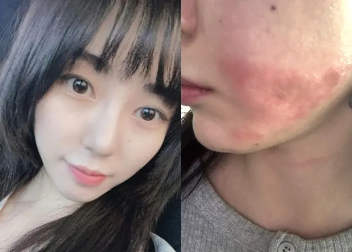 權珉娥施打醫美音波臉部遭二度灼傷。(圖/翻攝自韓網)