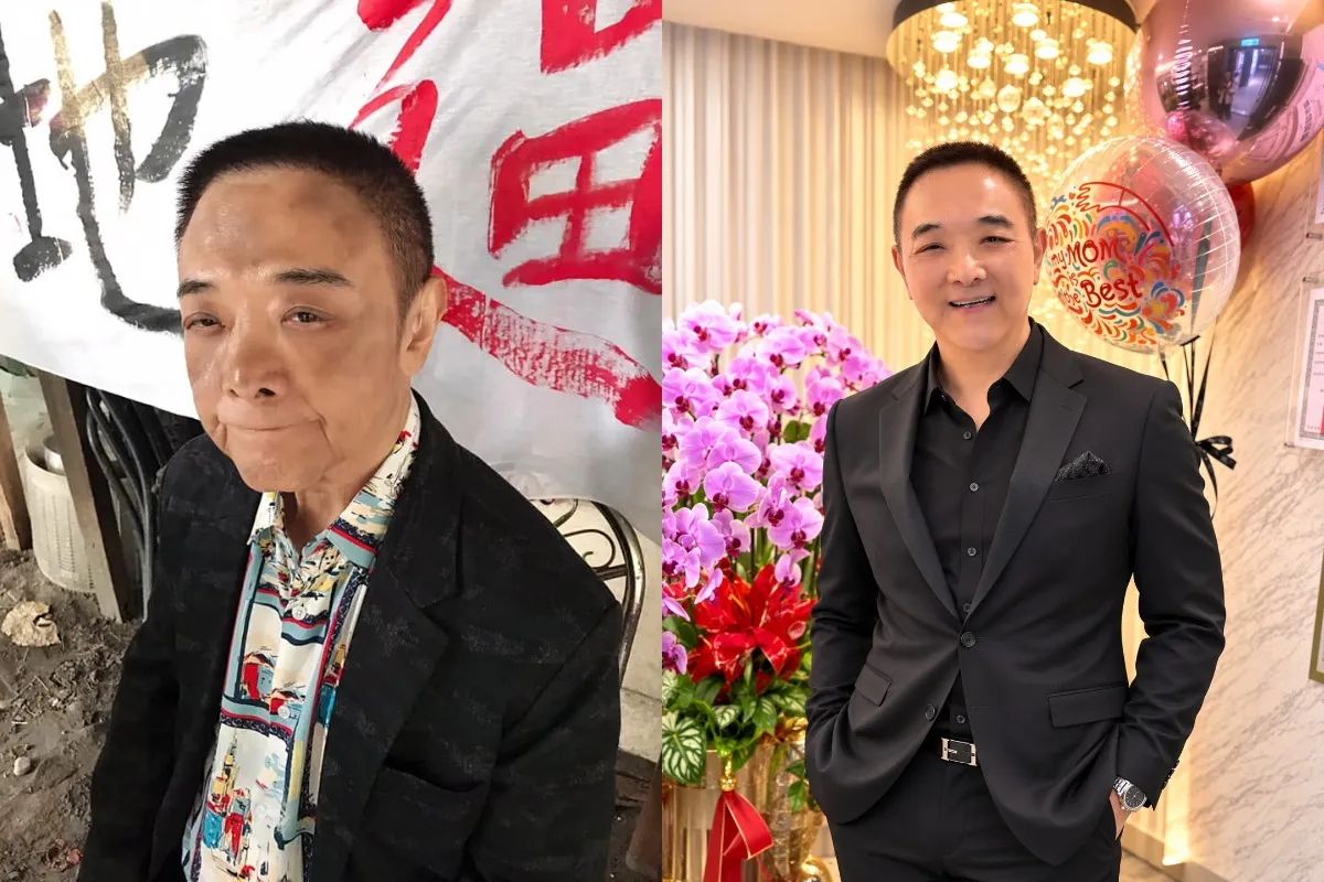 小亮哥(左圖)手術前老態藏不住,手術後緊繃到不行(右圖)。(圖/翻攝臉書、陽光璨亮整型生醫集團提供)