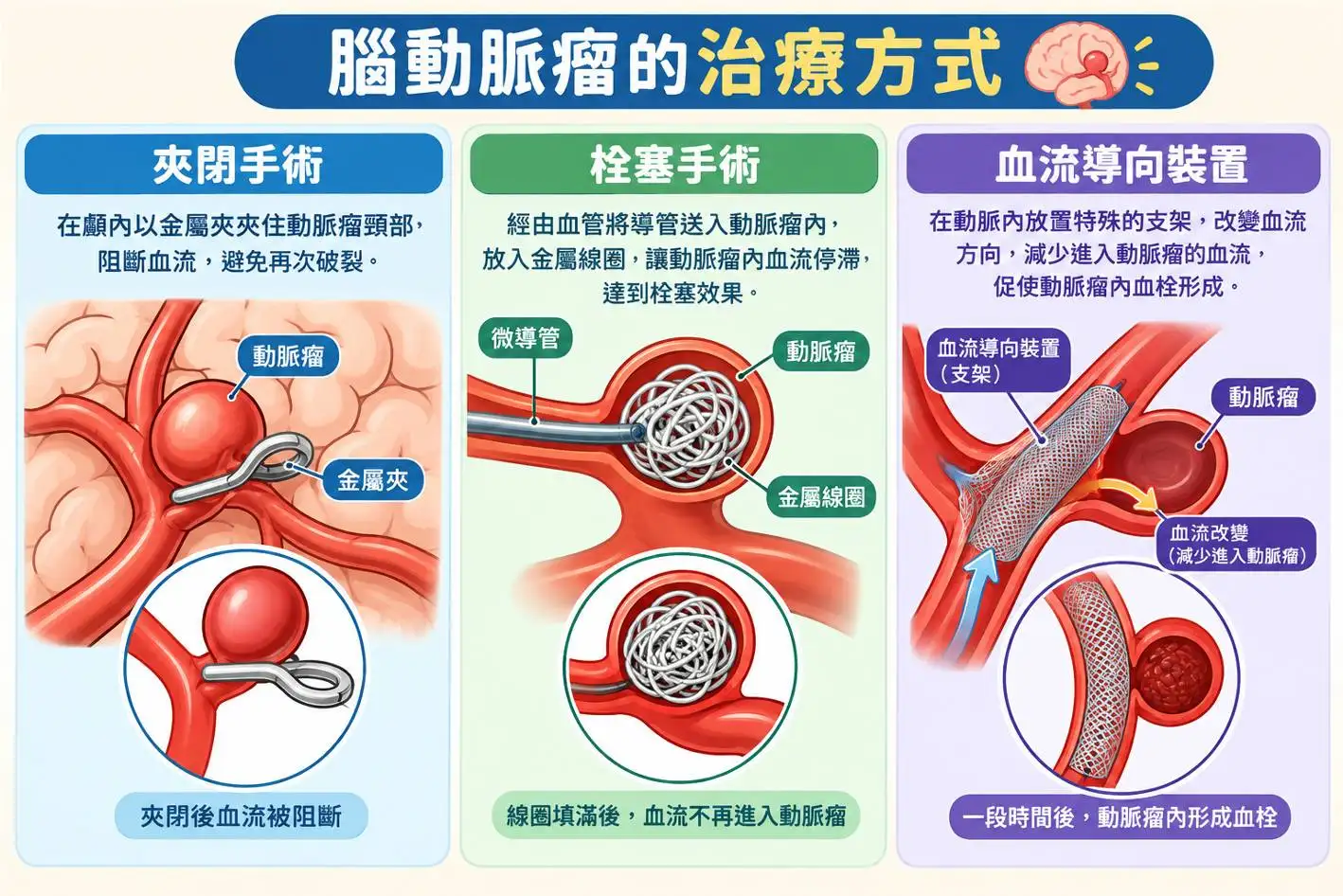 腦動脈瘤的治療方式。(圖/長庚醫院提供)